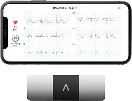 AliveCor KardiaMobile 6-Lead Personal EKG Monitor – Six Views of The Heart – Detects AFib and Irregular Arrhythmias – Instant Results in 30 Seconds – Works with Most Smartphones